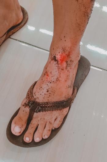 bloody wound on foot that's wearing flip flops